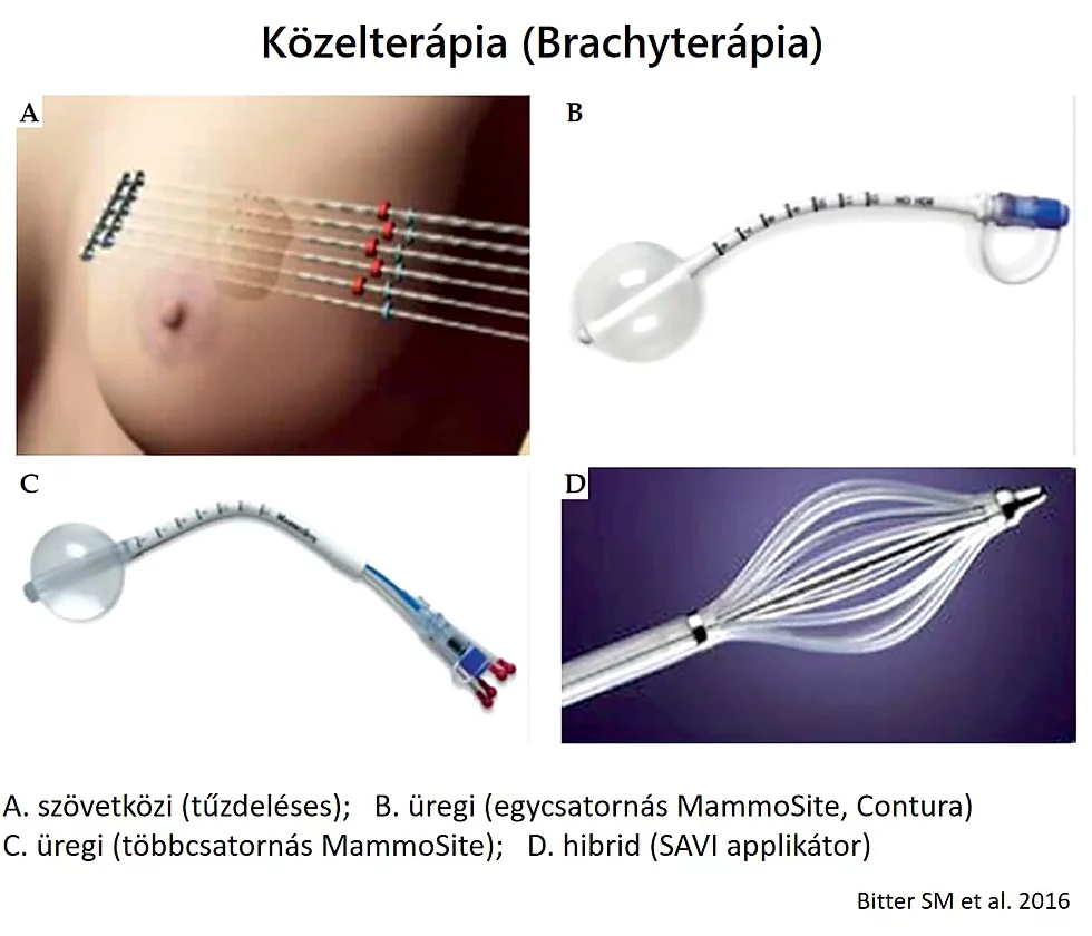 emlődaganat, mellrák, sugárterápia, radioterápia, brachyterápia, közelterápia, teleterápia, Intenzitásmodulált sugárterápia (IMRT), Képvezérelt sugárkezelés