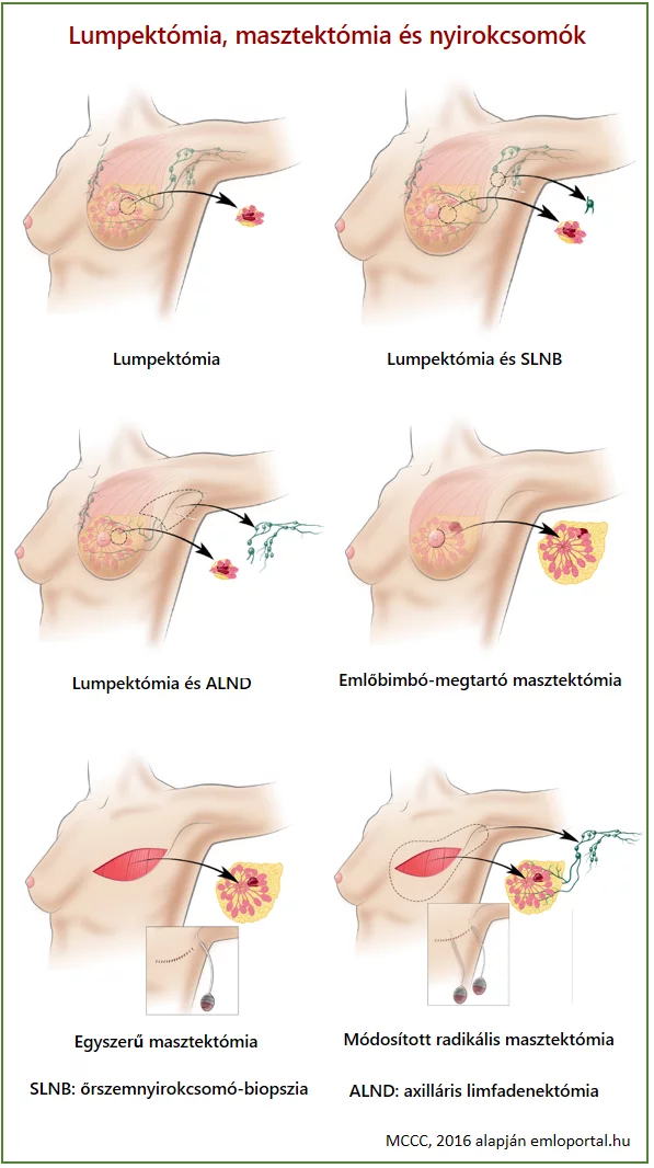 lumpektőmia, masztektőmia, nyirokcsomók radikális, módosított masztektómia
